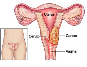 cervical cacner screening - Illustration