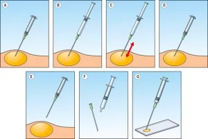 Illustration of Fine Needle Aspiration Procedure