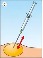 Fine Needle Aspiration (FNA) Cytology: A Tool for Quick Diagnosis