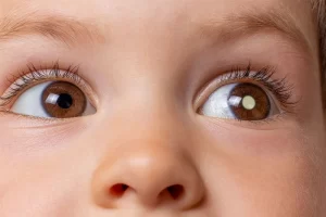 Retinoblastoma- leucokorrhea Retinoblastoma: Typical presentation