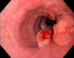 Esophageal Cancer in Kenya