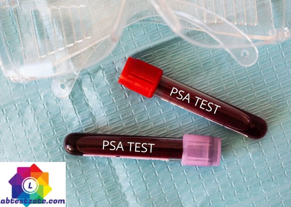 Prostatic Specific Antigen