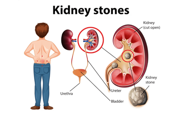 Kidney Stones (Nephrolithiasis): Understanding A dreaded painful renal condition